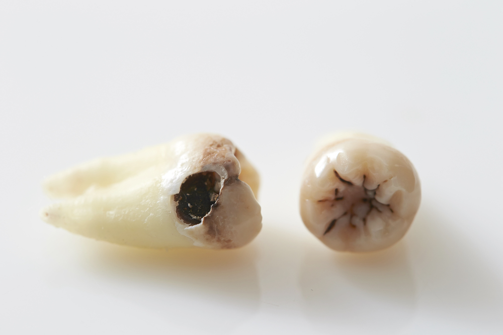 ①虫歯による口臭