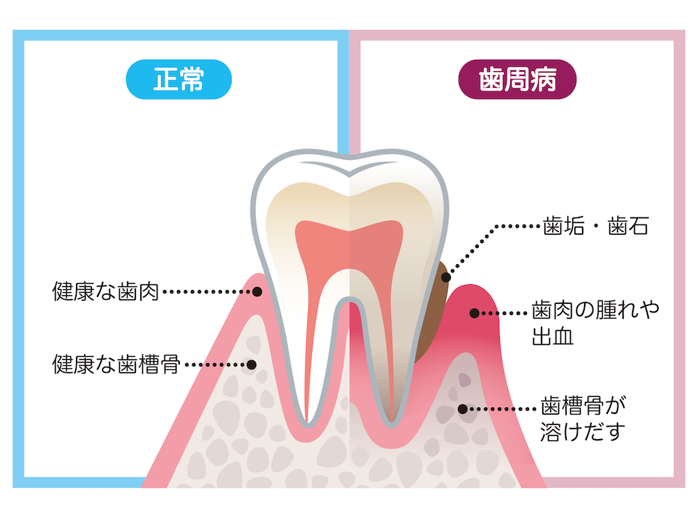 歯周病による口臭