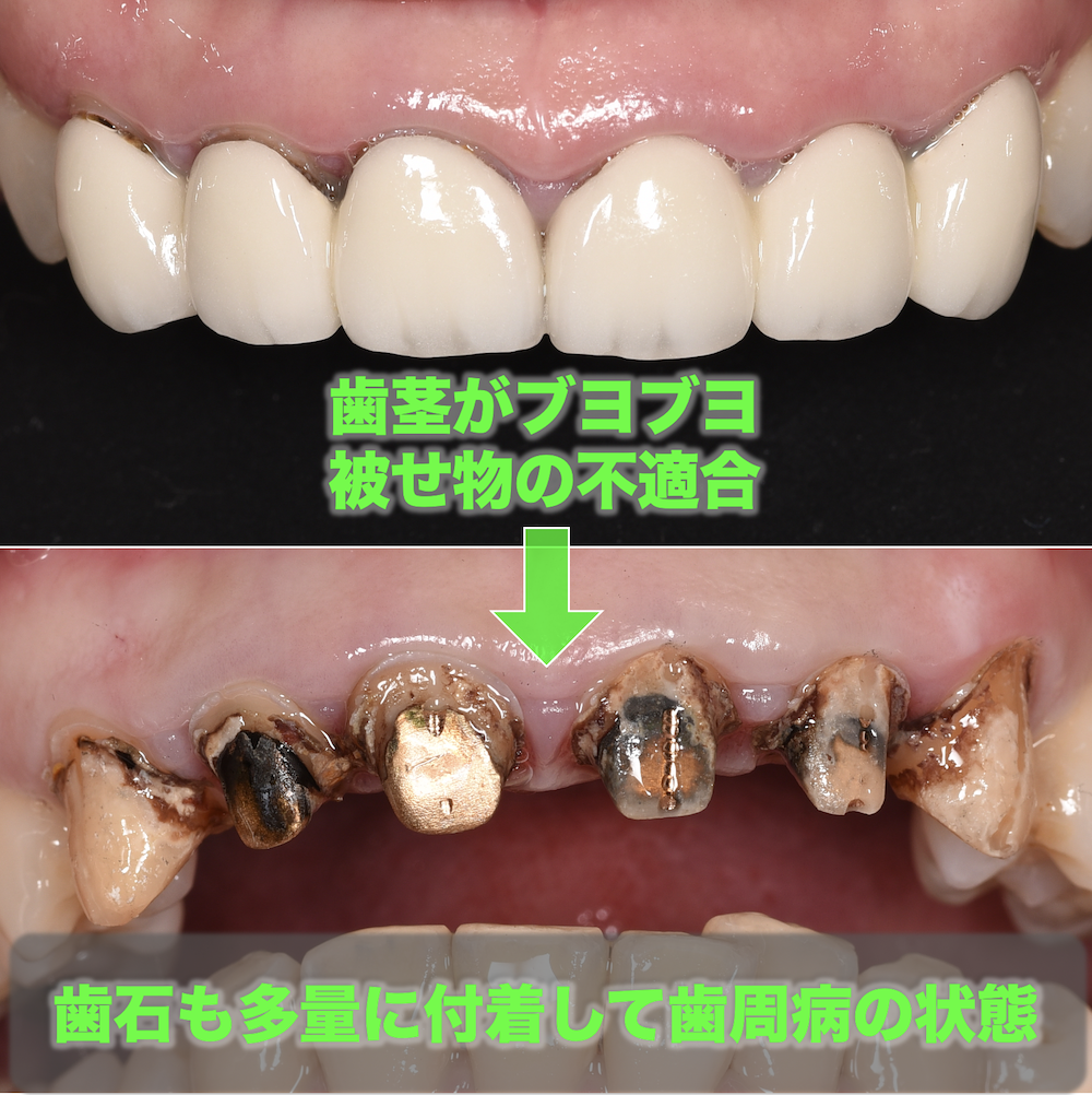 セラミック矯正した箇所が歯周病になっている