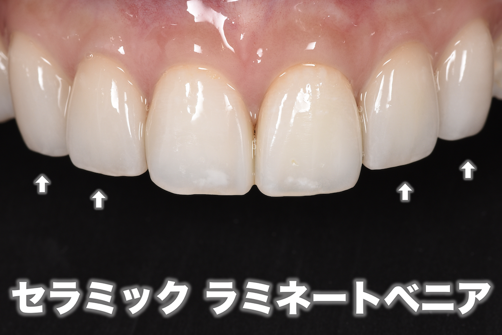 ②歯列だけで無く歯の色や形までコントロールできる