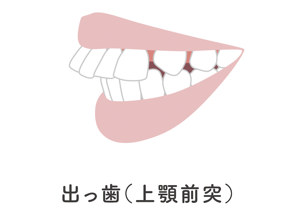 ラミネートベニアで出っ歯の治療は難しい？
