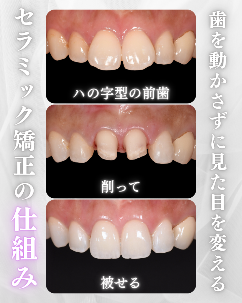 歯を動かさずに見た目を変える｜セラミック矯正の仕組み