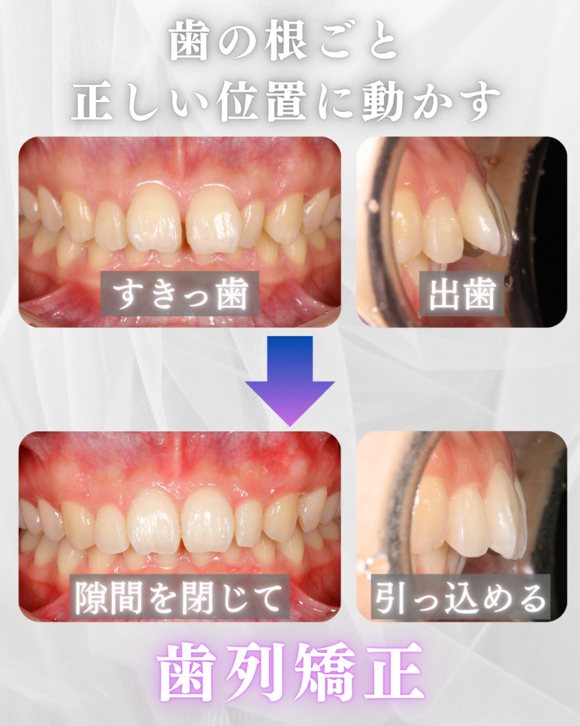 歯列矯正は「歯の根ごと正しい位置に動かす」治療