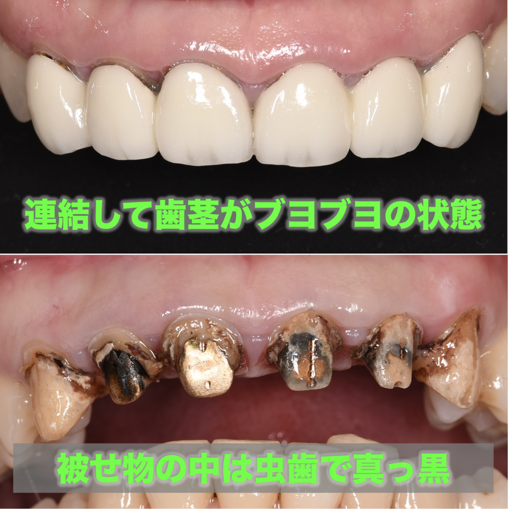 連結して歯茎がブヨブヨの状態