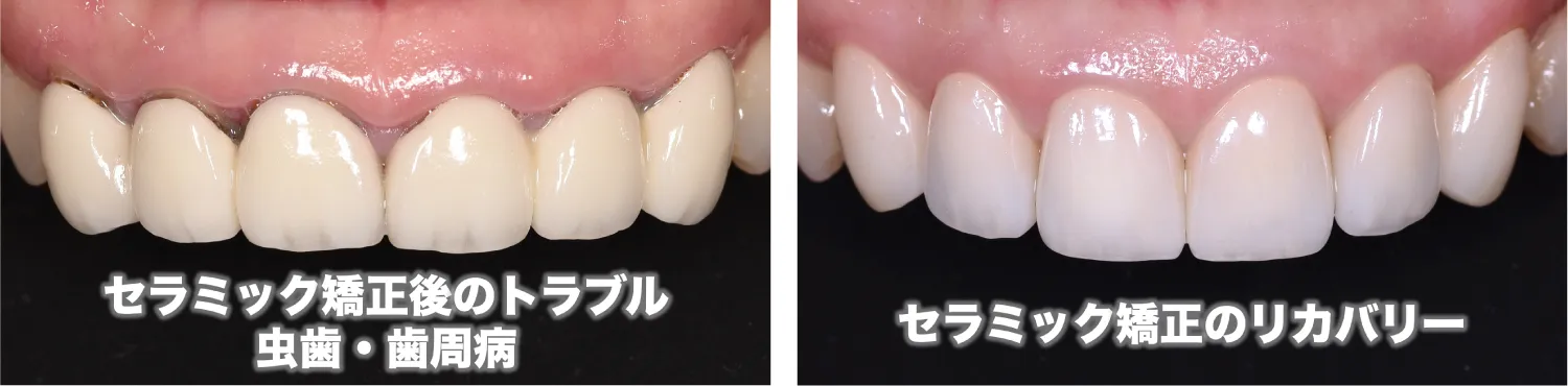 セラミック矯正のやり直し