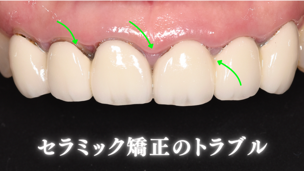 セラミック矯正のトラブル