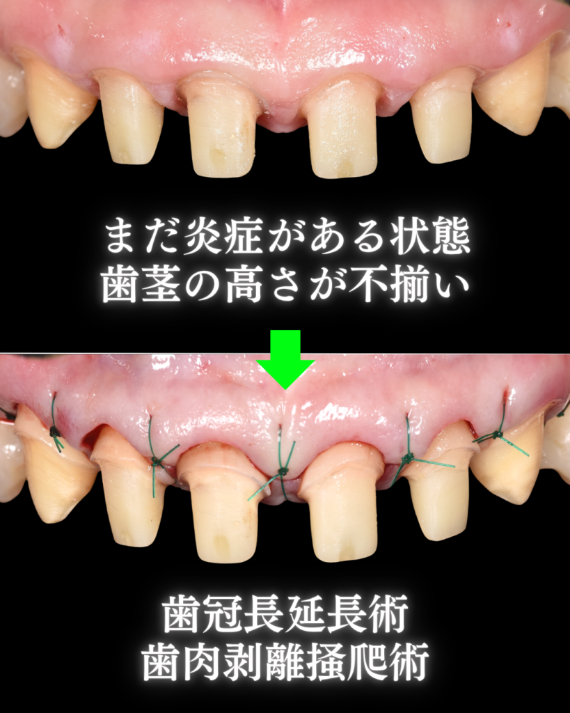 歯冠長延長術
歯肉剥離搔爬術