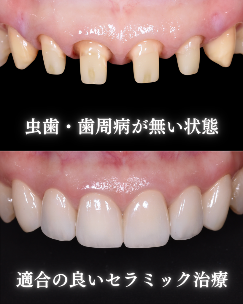 虫歯・歯周病がない状態
適合の良いセラミック