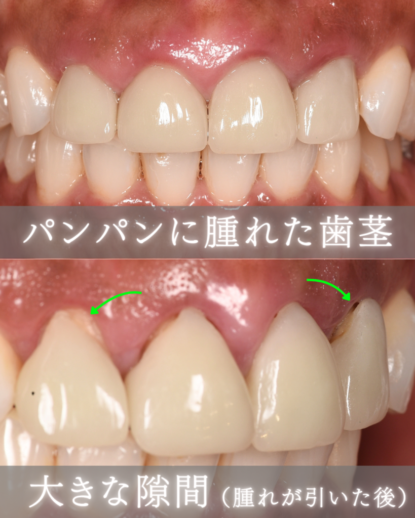 パンパンに腫れた歯茎
大きな隙間