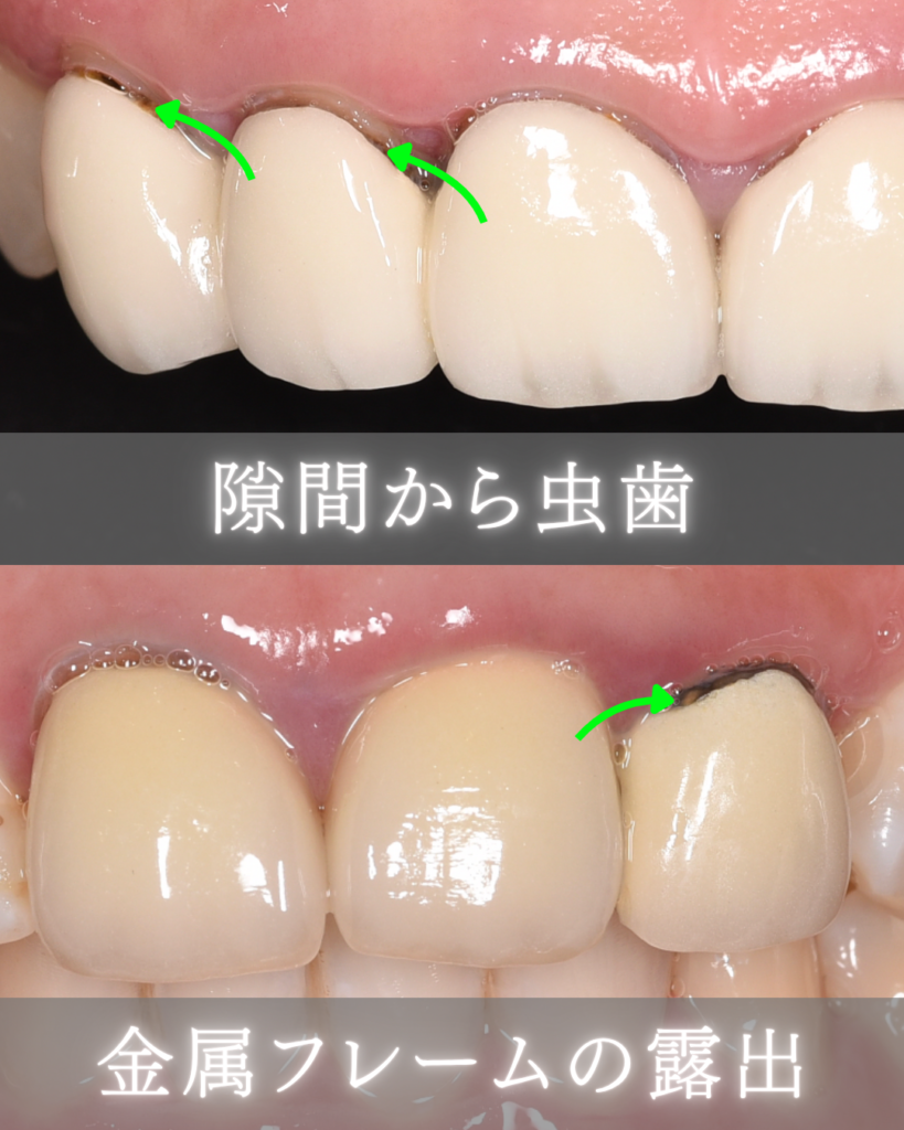 隙間から虫歯
金属フレームの露出