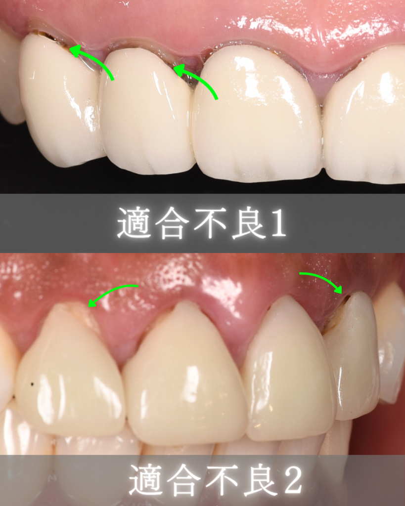 適合不良