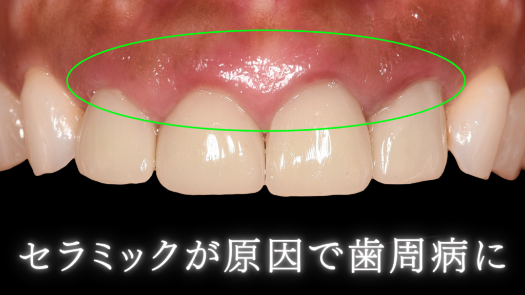 セラミックが原因で歯周病に