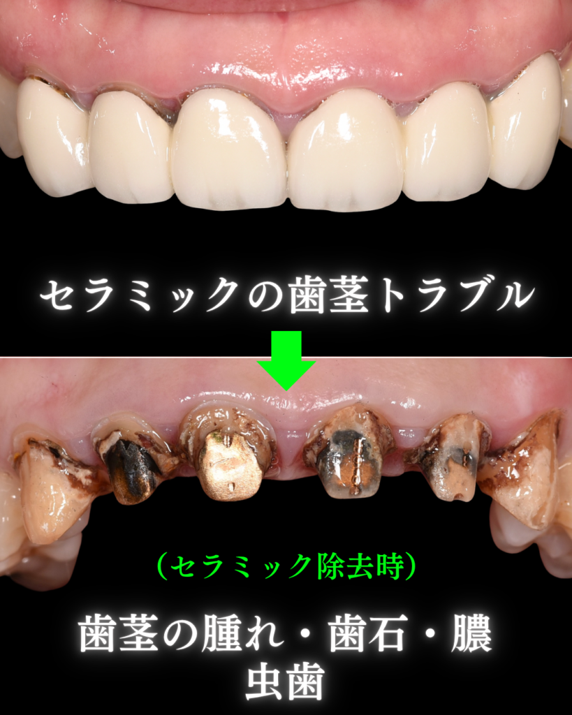 セラミック治療の歯茎トラブル