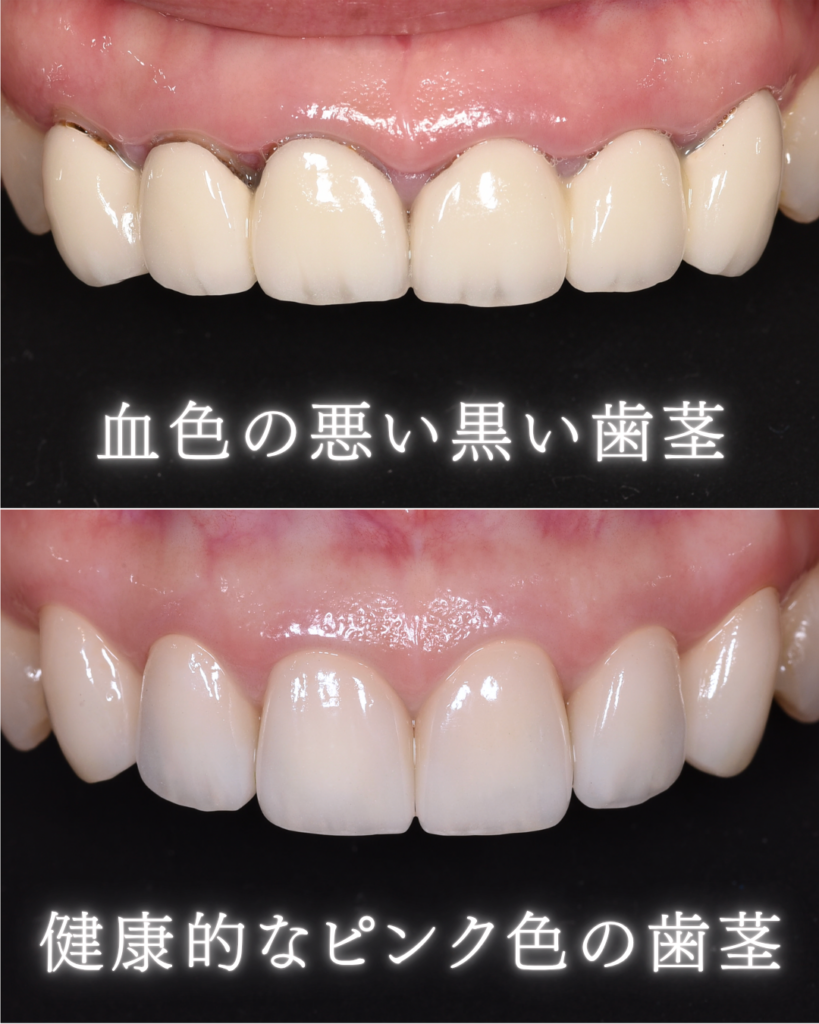 血色の悪い黒い歯茎
健康的なピンクの歯茎