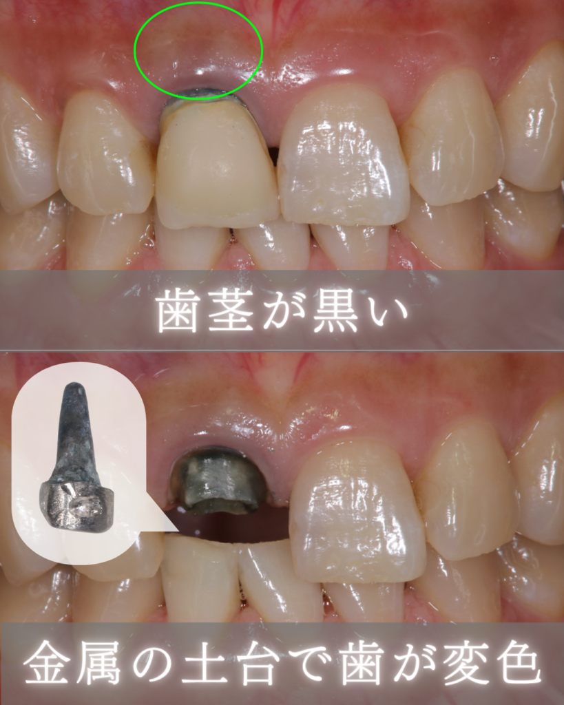 歯茎が黒い
金属の土台で歯が変色