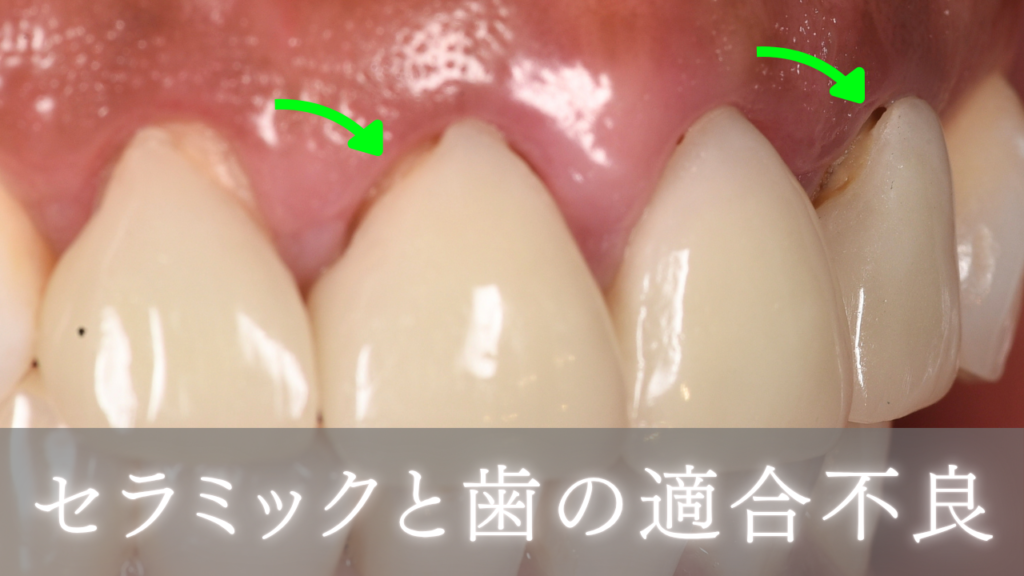 セラミックと歯の適合不良